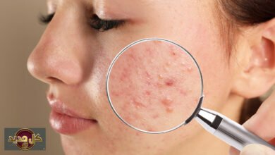 الغذاء وحب الشباب: هل الشوكولاتة والألبان وراء تفاقم البثور؟