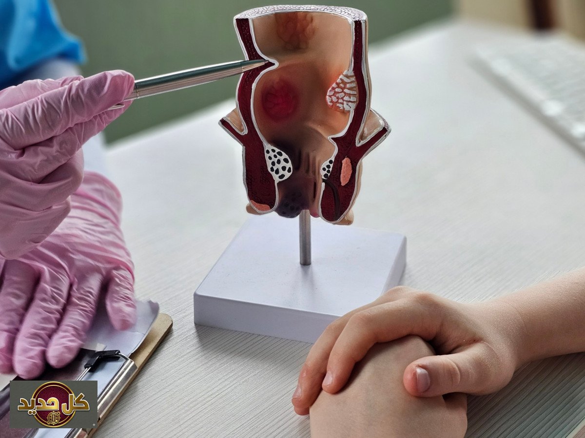 جراحة البواسير: متى يصبح التدخل الجراحي أمراً حتمياً وضرورياً؟