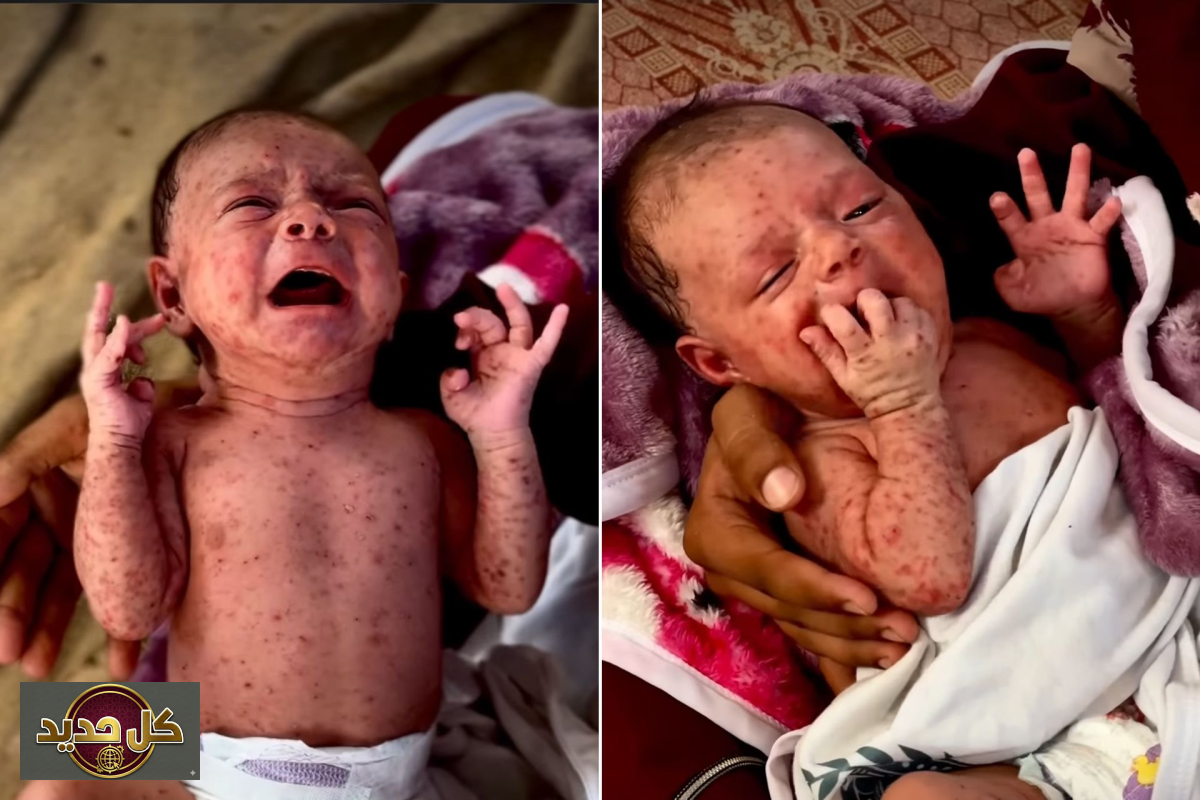 جدري الماء في غزة: وباء يهدد حياة الأطفال في مخيمات النزوح