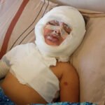 علاج الطفلة مسك: قصف إسرائيلي يحول حياتها لجحيم.. والعائلة تناشد بالخارج