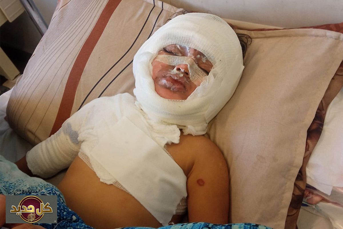 علاج الطفلة مسك: قصف إسرائيلي يحول حياتها لجحيم.. والعائلة تناشد بالخارج